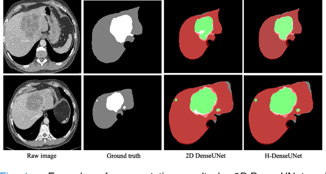 Figure 4 for H-DenseUNet: Hybrid Densely Connected UNet for Liver and Tumor Segmentation from CT Volumes