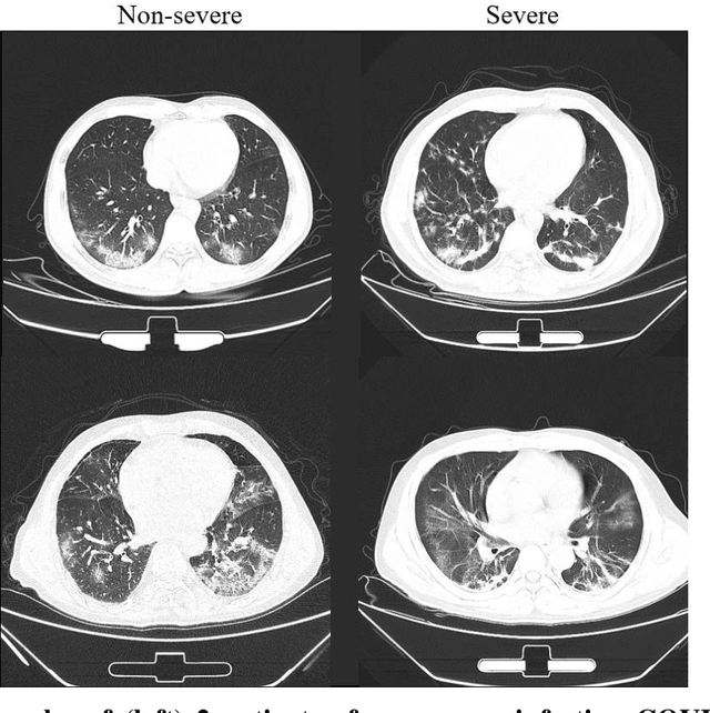 Figure 2 for Severity Assessment of Coronavirus Disease 2019 (COVID-19) Using Quantitative Features from Chest CT Images