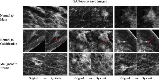 Figure 1 for Synthesizing lesions using contextual GANs improves breast cancer classification on mammograms