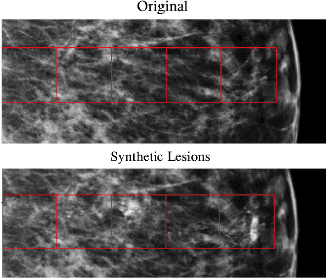 Figure 4 for Synthesizing lesions using contextual GANs improves breast cancer classification on mammograms