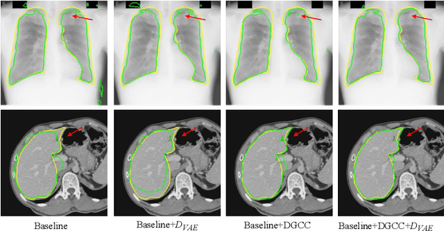 Figure 4 for Annotation-Efficient Learning for Medical Image Segmentation based on Noisy Pseudo Labels and Adversarial Learning