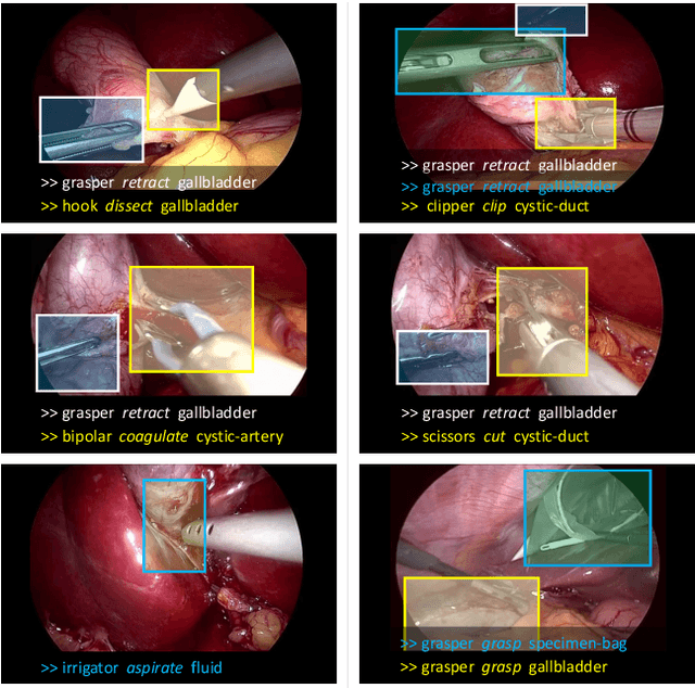 Figure 1 for Rendezvous: Attention Mechanisms for the Recognition of Surgical Action Triplets in Endoscopic Videos