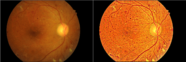 Figure 1 for Enhancement of Retinal Fundus Images via Pixel Color Amplification