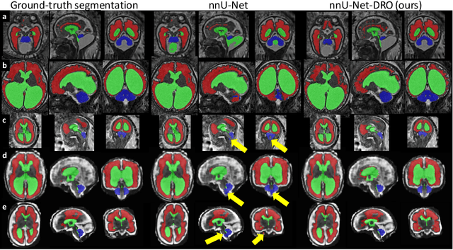 Figure 3 for Distributionally Robust Segmentation of Abnormal Fetal Brain 3D MRI