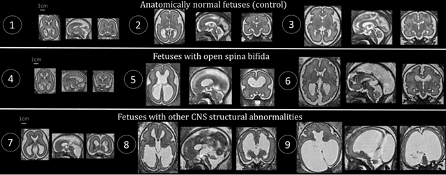 Figure 1 for Distributionally Robust Segmentation of Abnormal Fetal Brain 3D MRI