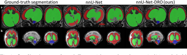 Figure 4 for Distributionally Robust Segmentation of Abnormal Fetal Brain 3D MRI