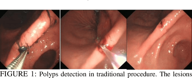 Figure 1 for Gastroscopic Panoramic View: Application to Automatic Polyps Detection under Gastroscopy