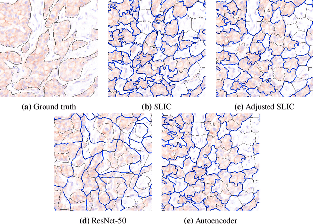 Figure 2 for Superpixel Pre-Segmentation of HER2 Slides for Efficient Annotation