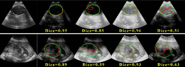 Figure 1 for Remove Appearance Shift for Ultrasound Image Segmentation via Fast and Universal Style Transfer