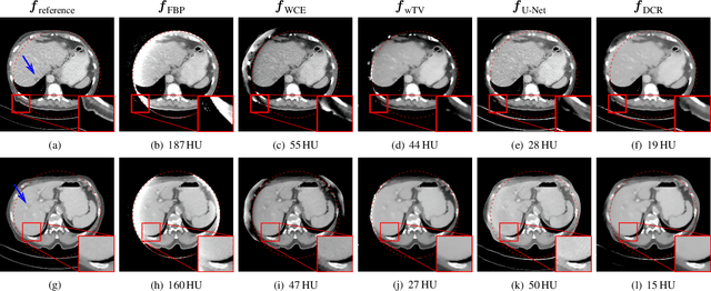 Figure 3 for Data Consistent CT Reconstruction from Insufficient Data with Learned Prior Images