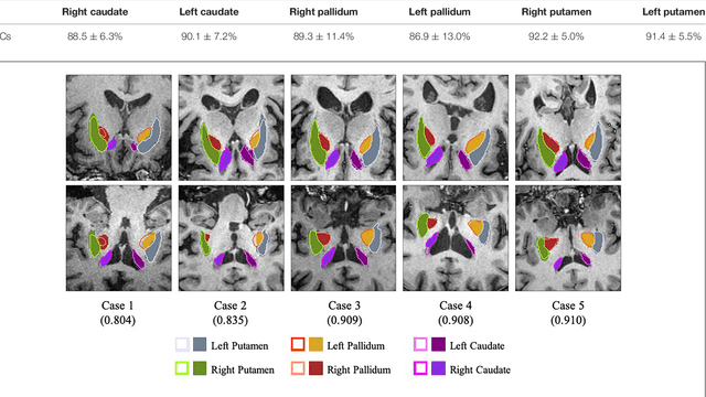 Figure 4 for A Fully-Automatic Framework for Parkinson's Disease Diagnosis by Multi-Modality Images