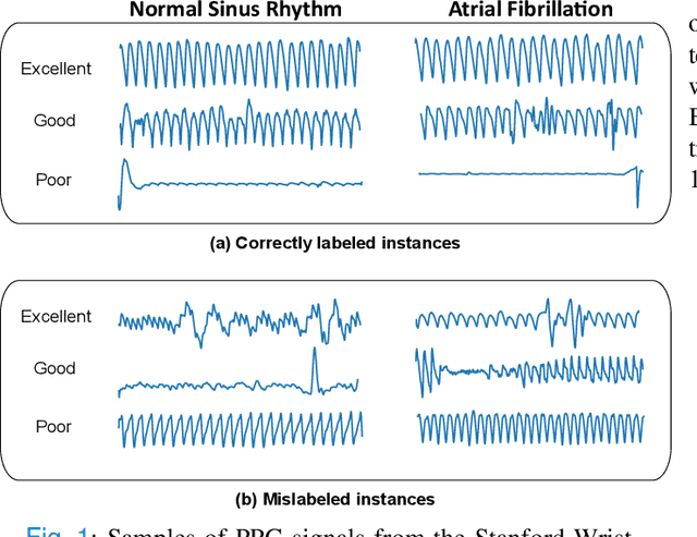 Figure 1 for BayesBeat: A Bayesian Deep Learning Approach for Atrial Fibrillation Detection from Noisy Photoplethysmography Data