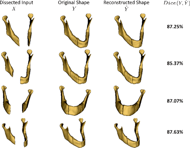 Figure 4 for Variational Shape Completion for Virtual Planning of Jaw Reconstructive Surgery