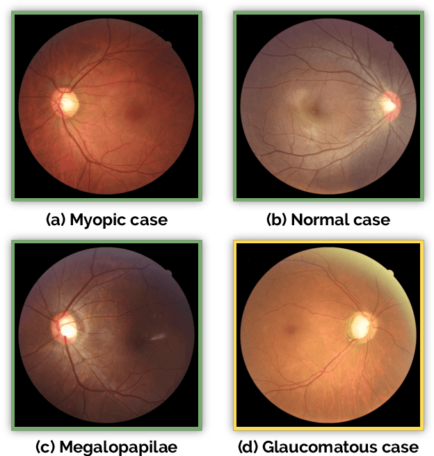 Figure 4 for REFUGE Challenge: A Unified Framework for Evaluating Automated Methods for Glaucoma Assessment from Fundus Photographs