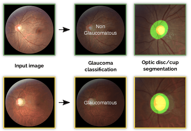 Figure 1 for REFUGE Challenge: A Unified Framework for Evaluating Automated Methods for Glaucoma Assessment from Fundus Photographs