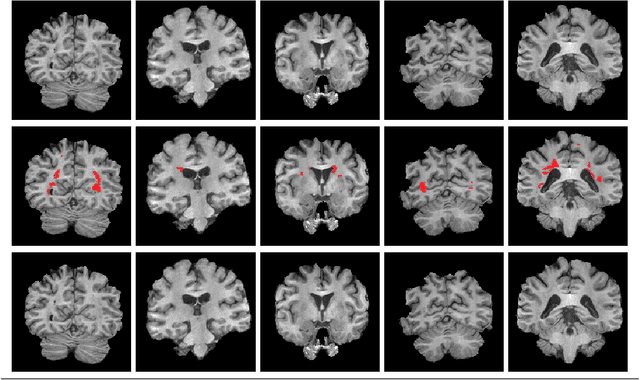 Figure 1 for Multiple Sclerosis Lesion Inpainting Using Non-Local Partial Convolutions