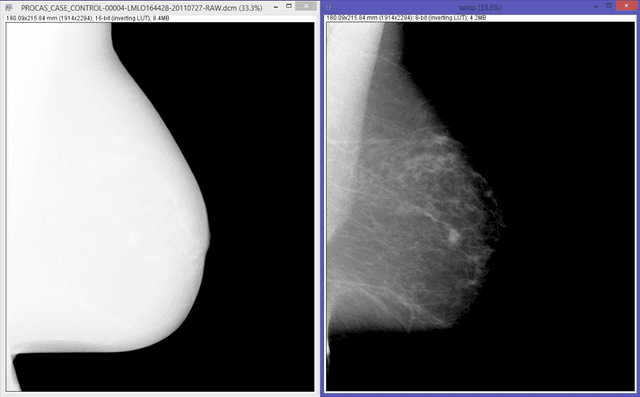 Figure 1 for A novel and automatic pectoral muscle identification algorithm for mediolateral oblique (MLO) view mammograms using ImageJ