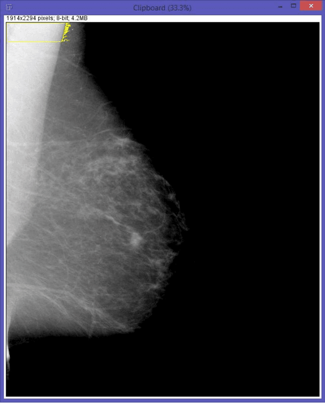 Figure 2 for A novel and automatic pectoral muscle identification algorithm for mediolateral oblique (MLO) view mammograms using ImageJ