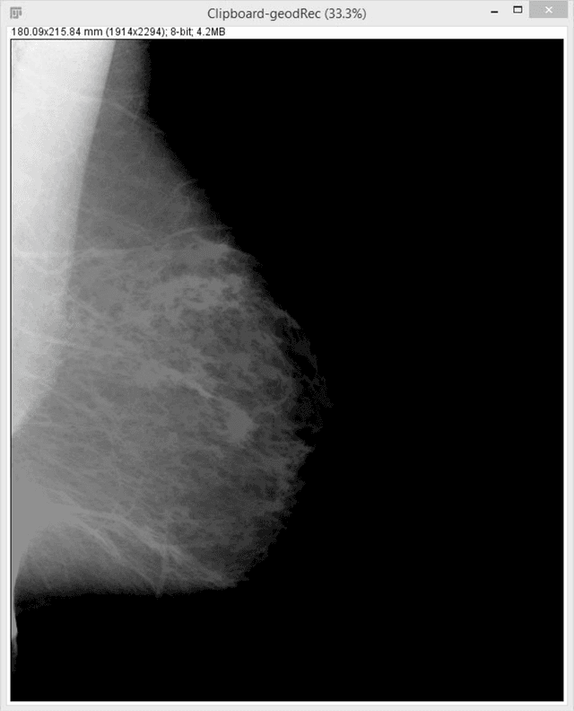 Figure 3 for A novel and automatic pectoral muscle identification algorithm for mediolateral oblique (MLO) view mammograms using ImageJ