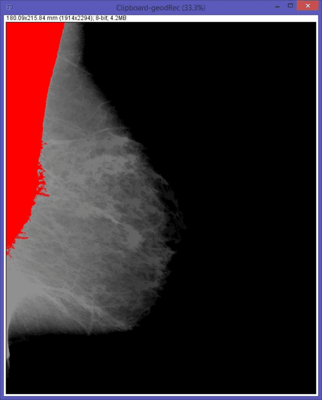 Figure 4 for A novel and automatic pectoral muscle identification algorithm for mediolateral oblique (MLO) view mammograms using ImageJ