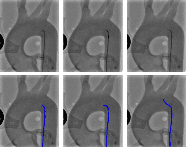 Figure 1 for End-to-End Real-time Catheter Segmentation with Optical Flow-Guided Warping during Endovascular Intervention