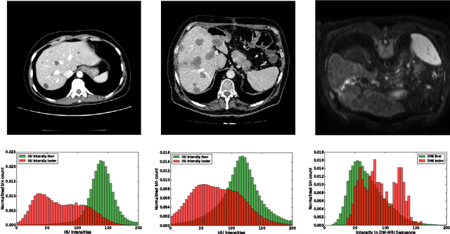 Figure 1 for Automatic Liver and Tumor Segmentation of CT and MRI Volumes using Cascaded Fully Convolutional Neural Networks