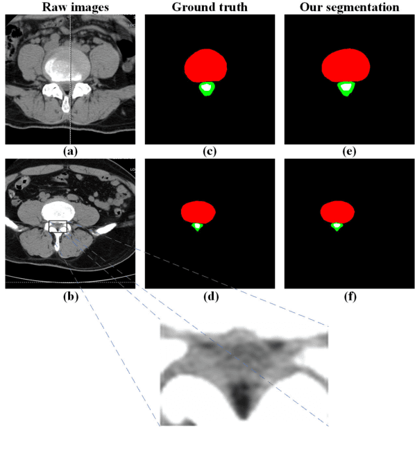 Figure 1 for Automatic Lumbar Spinal CT Image Segmentation with a Dual Densely Connected U-Net
