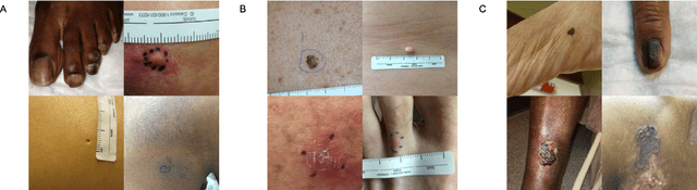 Figure 1 for Disparities in Dermatology AI: Assessments Using Diverse Clinical Images