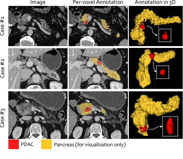 Figure 1 for Learning Inductive Attention Guidance for Partially Supervised Pancreatic Ductal Adenocarcinoma Prediction