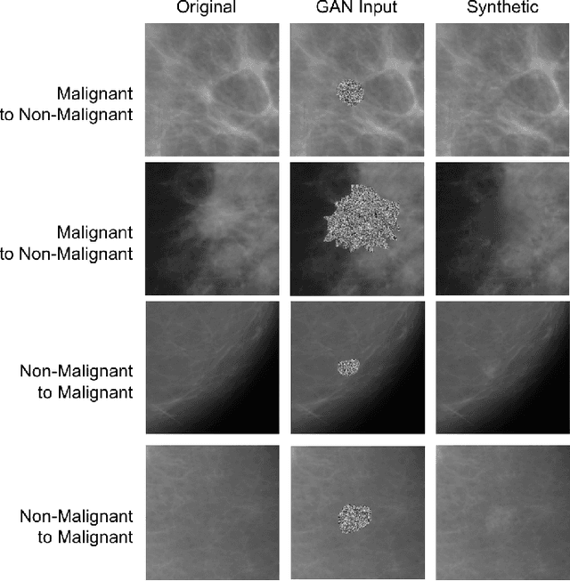 Figure 1 for Conditional Infilling GANs for Data Augmentation in Mammogram Classification