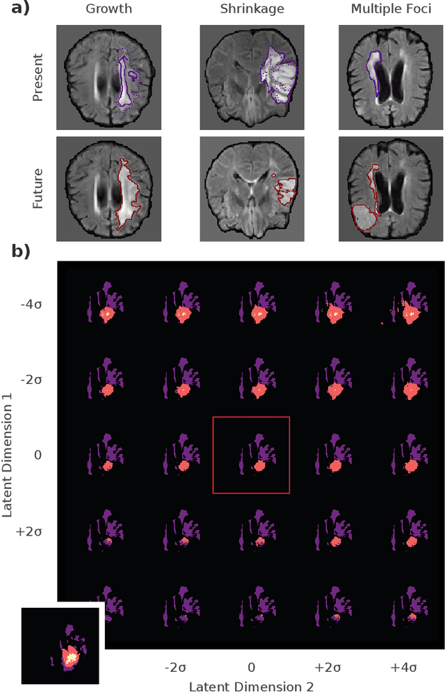 Figure 2 for Deep Probabilistic Modeling of Glioma Growth