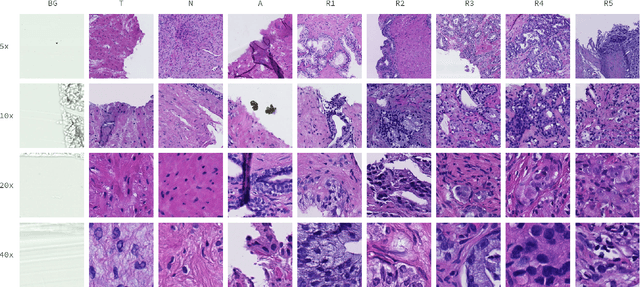 Figure 1 for DiagSet: a dataset for prostate cancer histopathological image classification