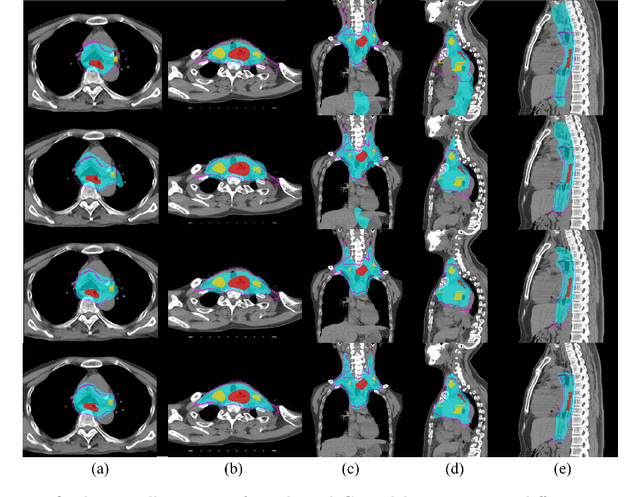 Figure 4 for Deep Esophageal Clinical Target Volume Delineation using Encoded 3D Spatial Context of Tumors, Lymph Nodes, and Organs At Risk