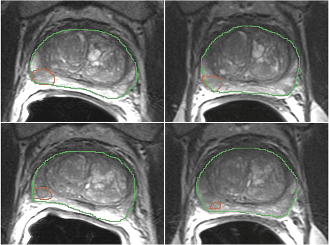 Figure 1 for Repeatability of Multiparametric Prostate MRI Radiomics Features