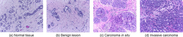 Figure 1 for Application of Transfer Learning and Ensemble Learning in Image-level Classification for Breast Histopathology