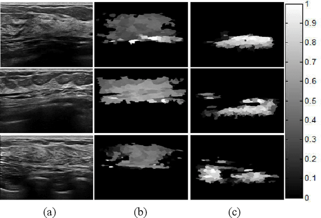 Figure 2 for Tumor Saliency Estimation for Breast Ultrasound Images via Breast Anatomy Modeling