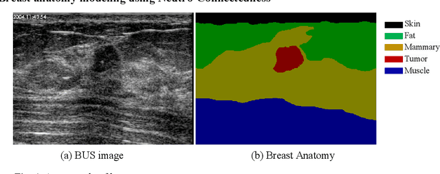 Figure 4 for Tumor Saliency Estimation for Breast Ultrasound Images via Breast Anatomy Modeling