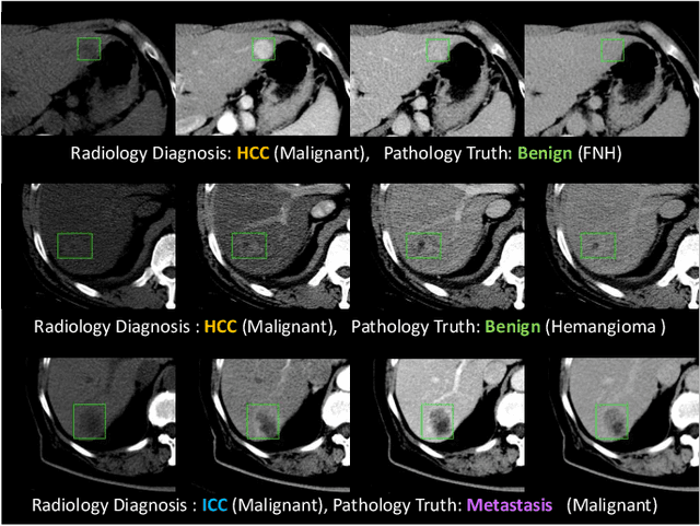 Figure 1 for Harvesting, Detecting, and Characterizing Liver Lesions from Large-scale Multi-phase CT Data via Deep Dynamic Texture Learning