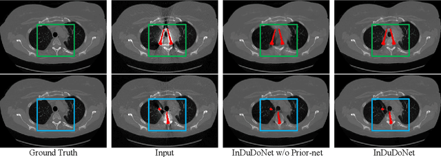 Figure 3 for InDuDoNet+: A Model-Driven Interpretable Dual Domain Network for Metal Artifact Reduction in CT Images