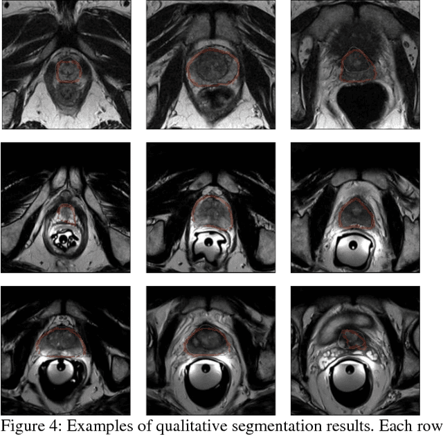 Figure 2 for Densely Dilated Spatial Pooling Convolutional Network using benign loss functions for imbalanced volumetric prostate segmentation