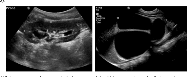 Figure 1 for Subsequent Boundary Distance Regression and Pixelwise Classification Networks for Automatic Kidney Segmentation in Ultrasound Images