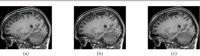 Figure 3 for A self-supervised learning strategy for postoperative brain cavity segmentation simulating resections