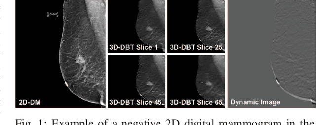 Figure 1 for 2D Convolutional Neural Networks for 3D Digital Breast Tomosynthesis Classification