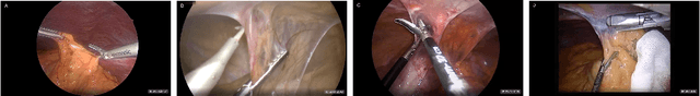 Figure 1 for "Train one, Classify one, Teach one" -- Cross-surgery transfer learning for surgical step recognition