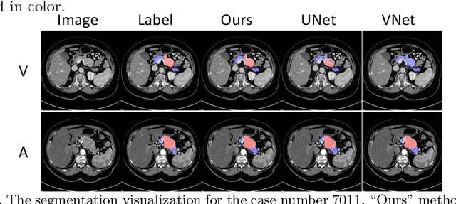 Figure 3 for Segmentation for Classification of Screening Pancreatic Neuroendocrine Tumors