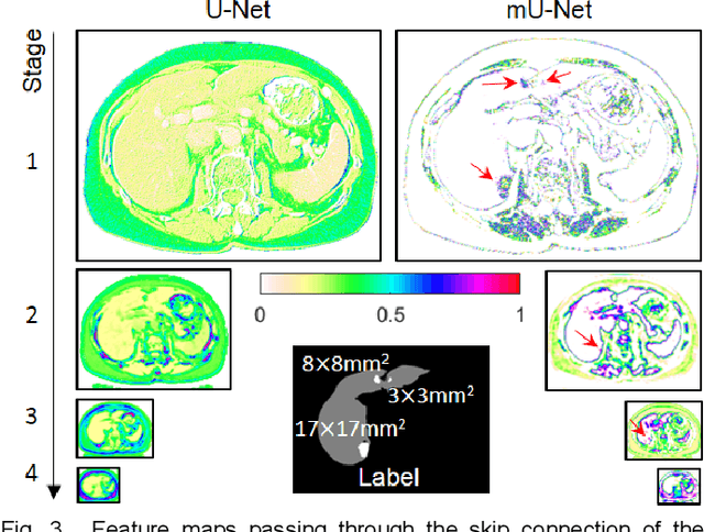 Figure 4 for Modified U-Net (mU-Net) with Incorporation of Object-Dependent High Level Features for Improved Liver and Liver-Tumor Segmentation in CT Images