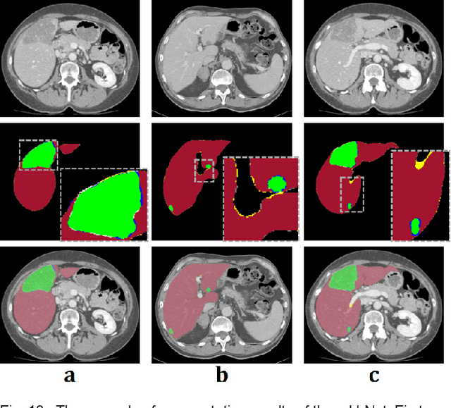 Figure 2 for Modified U-Net (mU-Net) with Incorporation of Object-Dependent High Level Features for Improved Liver and Liver-Tumor Segmentation in CT Images