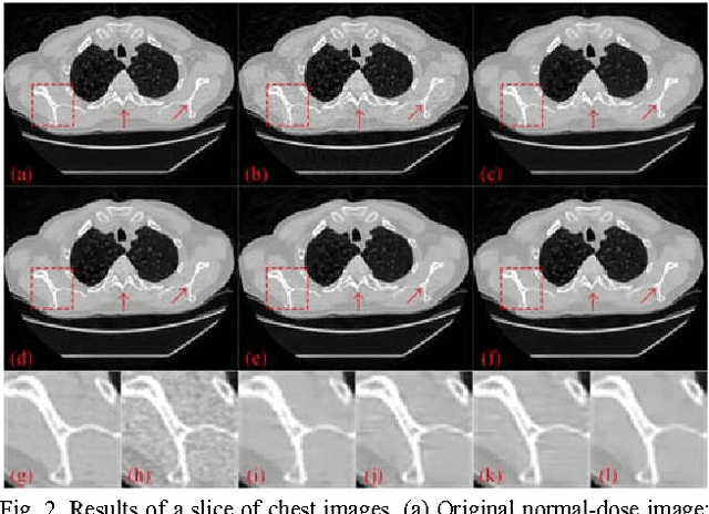 Figure 2 for Low-dose CT denoising with convolutional neural network
