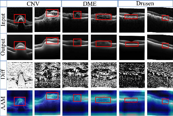 Figure 4 for Sparse-GAN: Sparsity-constrained Generative Adversarial Network for Anomaly Detection in Retinal OCT Image