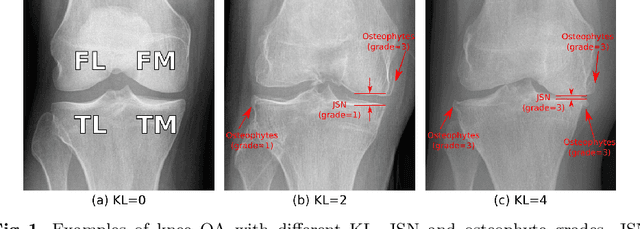 Figure 1 for Coherence Learning using Keypoint-based Pooling Network for Accurately Assessing Radiographic Knee Osteoarthritis